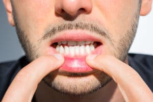crooked teeth in adults