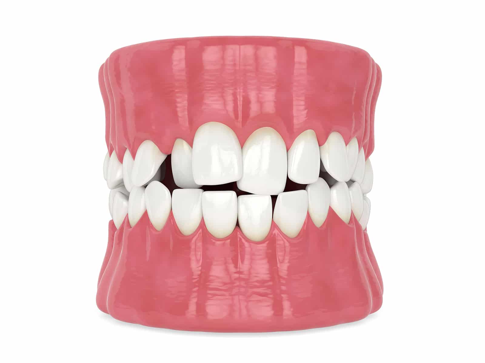 types of crooked teeth
